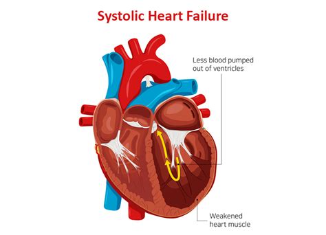 what causes systolic heart failure